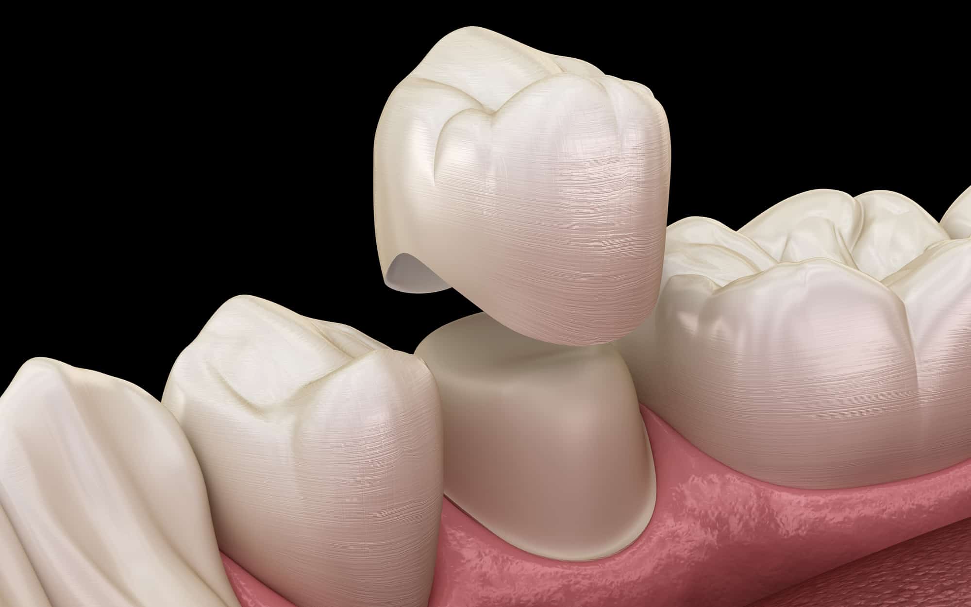 Kronen und Teilkronen – Zahnästhetik in Koblenz - Modell einer Keramik Krone