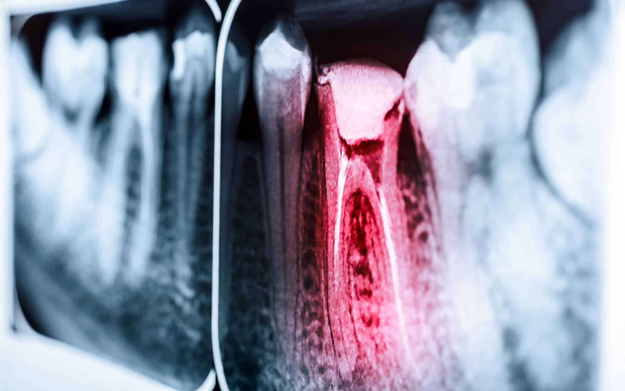 Wurzelbehandlung – Endodontie in Koblenz - Röntgenbild eines Zahnes mit Wurzelkanalentzündung